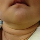 新生児の首