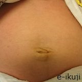 生後1ヶ月のへそ