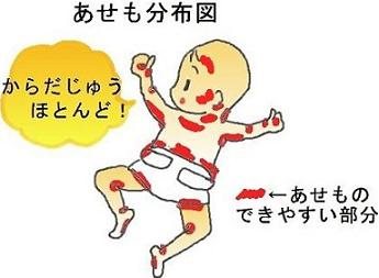 あせも